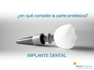 Implantes dentales | en que consiste la parte protésica