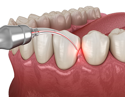 cirugia de encias | periodontitis tarragona