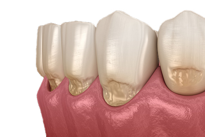 retraccion de encia por periodontitis