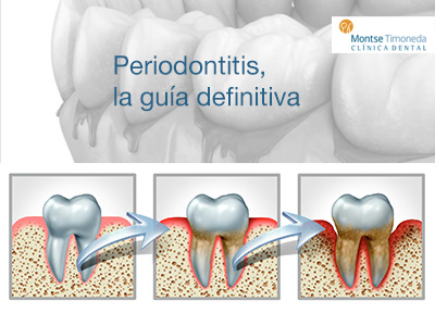 periodontitis, la guia definitiva