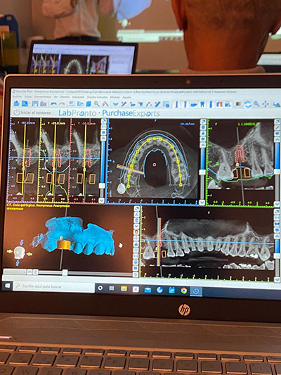 software de cirugía guiada para implantes e impresión 3D