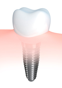 el mantenimiento de un implante dental