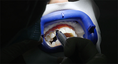 nueva tecnologia de blanqueamiento dental