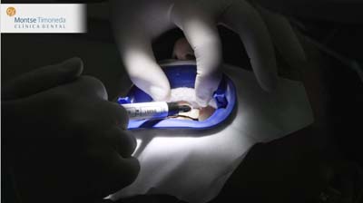 blanqueamiento dental en tarragona | con lampara LED