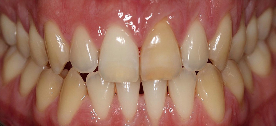 caso 5 antes | blanqueamiento dental