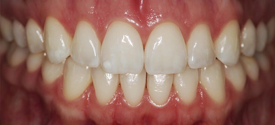 caso 6 despues | blanqueamiento dental