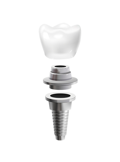 implante dental | cuánto cuesta