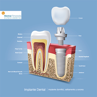 implante dental | detalles Montse Timoneda