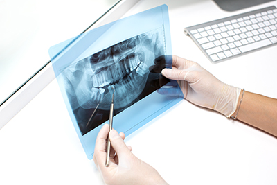 implante dental en radiografía