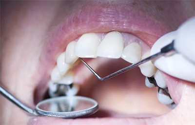 amalgamas dentales en buen estado
