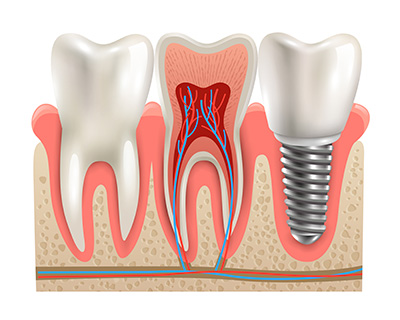 implante dental | colocación perfecta