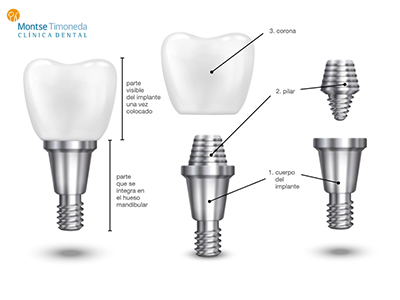 partes de un implante dental ok