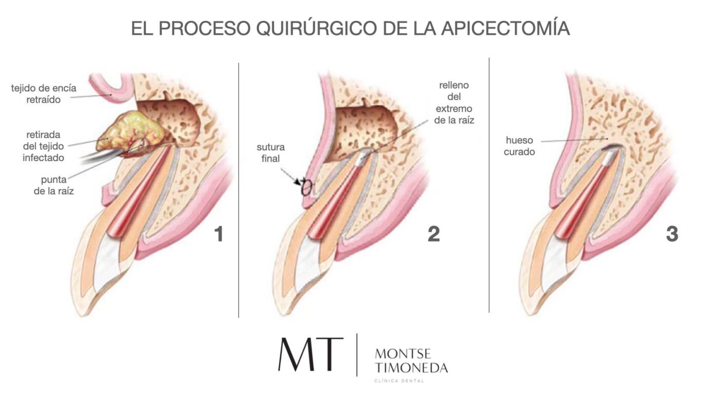 apicectomía infografía proceso quirurgico definitivo