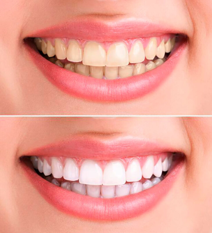 dientes blanqueados | blanqueamiento dental precio