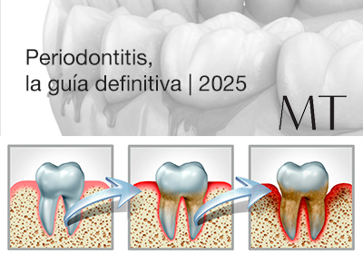 periodontitis, la guia definitiva 2025 ok 2