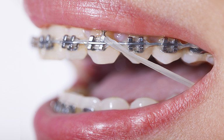 elasticos intermaxilares en ortodoncia de paciente