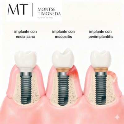 mplante con encia sana, implante con mucositis e implante de periimplantitis