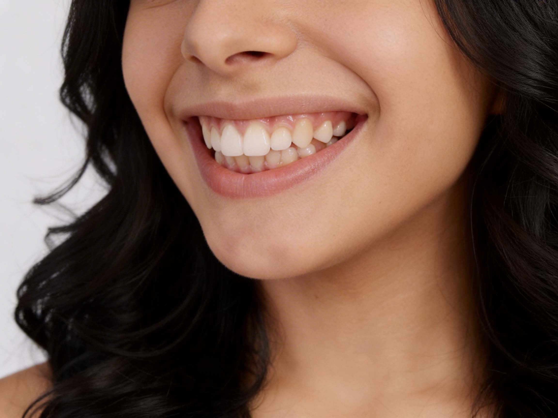 exposicion excesiva de las encias | sonrisa gingival