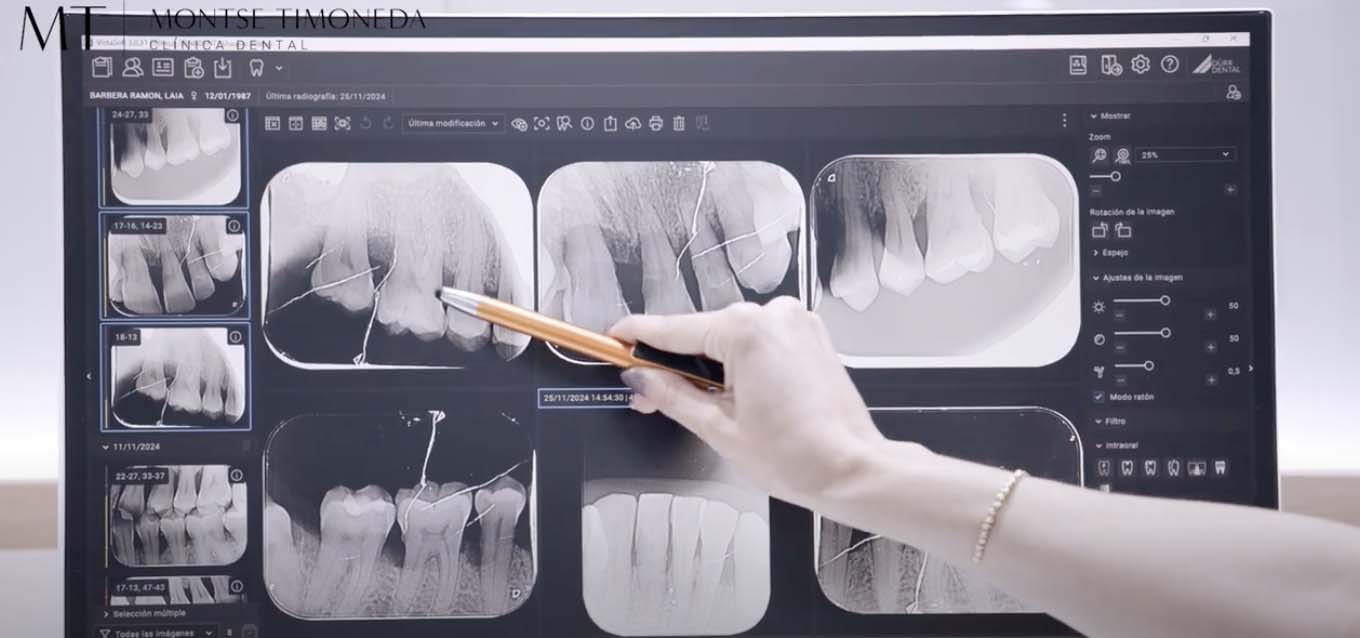 clinica dental montse timoneda atencion personalizada e integral | periodontitis tratamiento