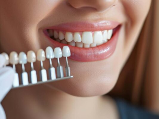 poner carillas dentales en clinica MT| carilla dental