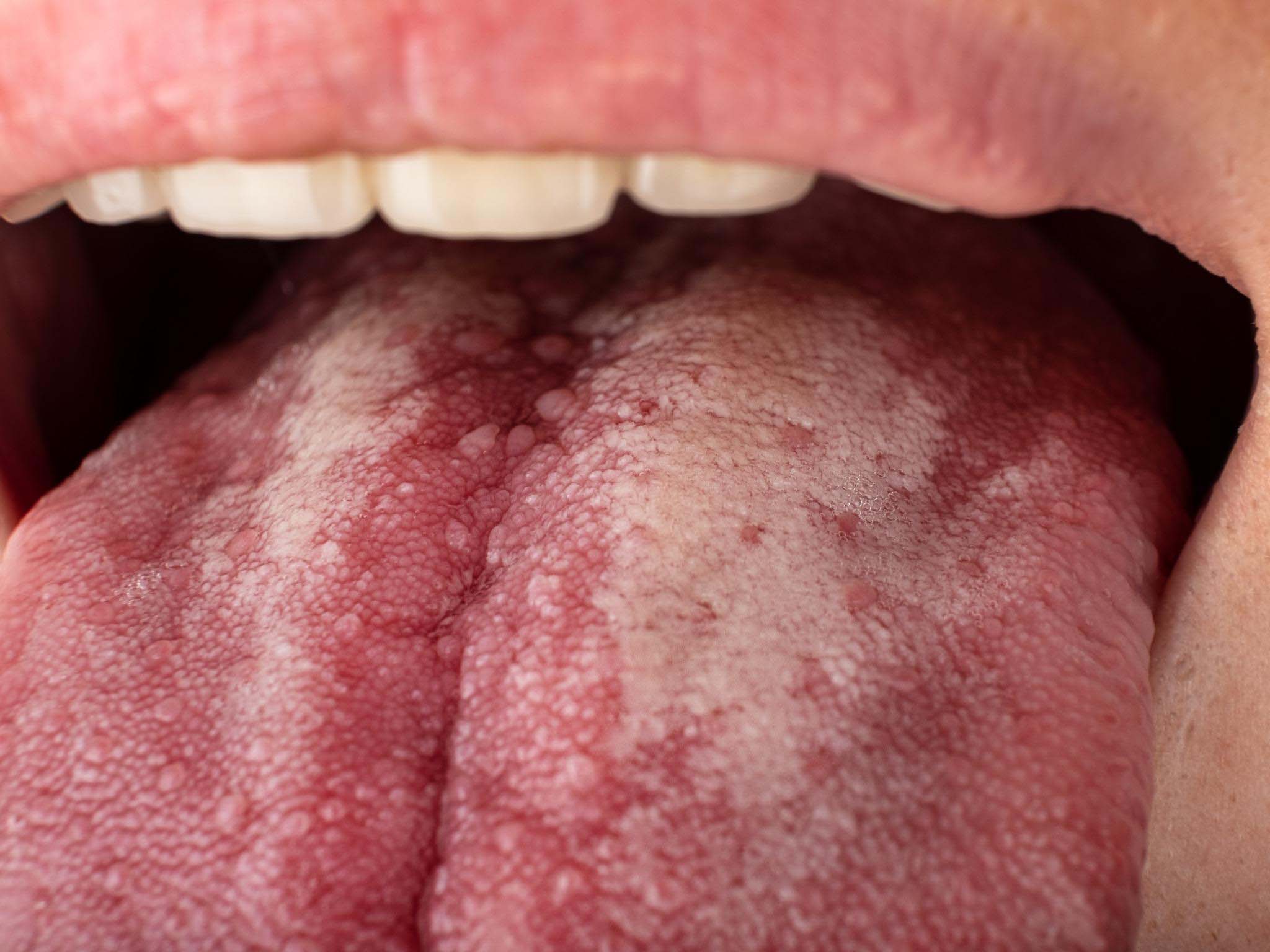 clinica dental de tarragona para tratar la mucositis oral | mucositis oral