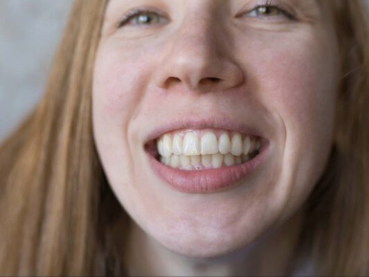 encia retraida olucion en clinica dental montse timoneda