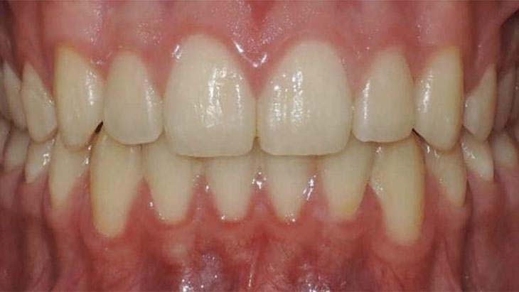 despues de ortodoncia invisible | Invisalign en Tarragona transforma tu sonrisa con una ortodoncia discreta y personalizada