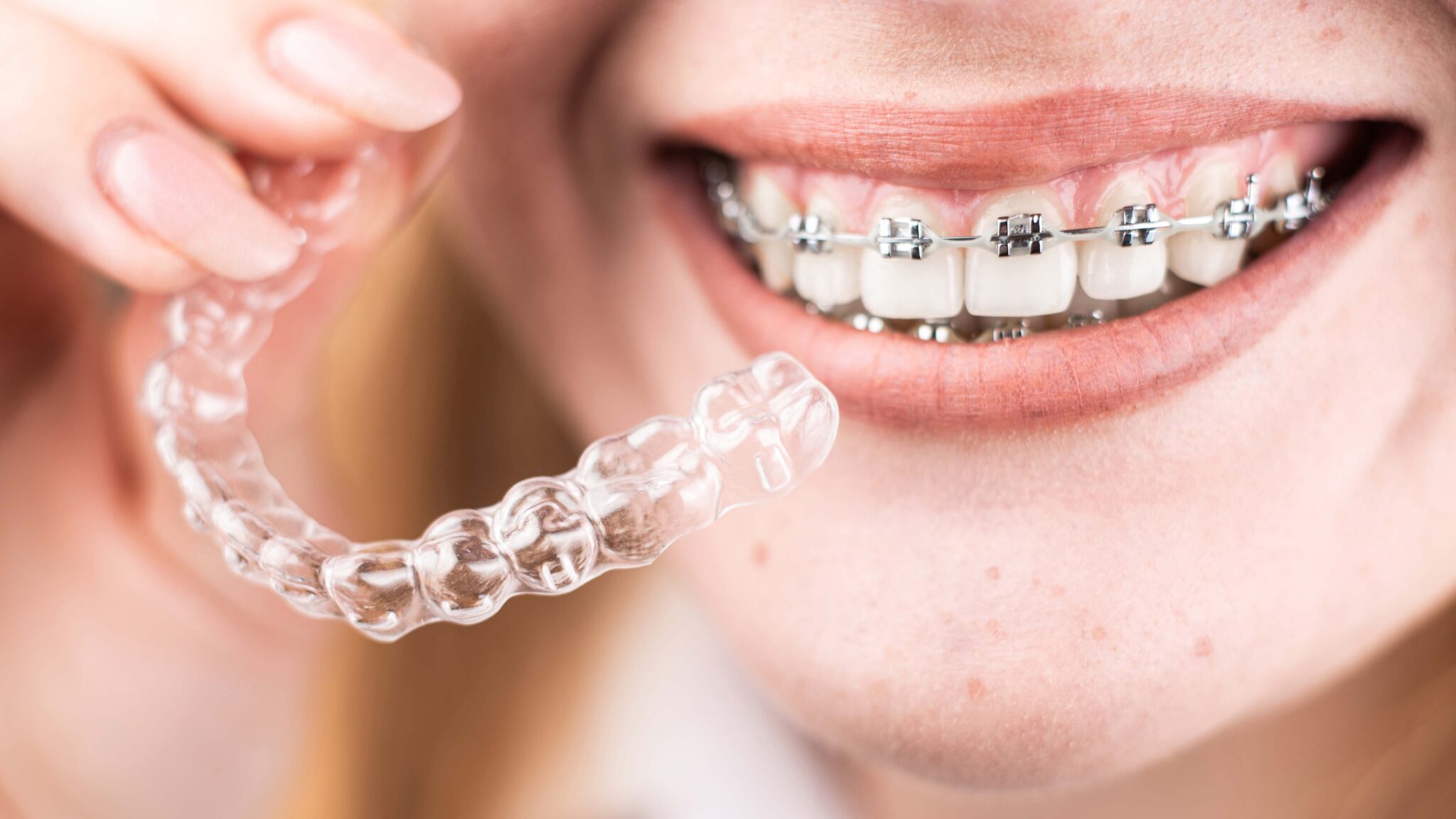 preguntas frecuentes sobre ortodoncia con brackets y alineadores | Brackets o Invisalign Descubre que tratamiento encaja mejor con tu sonrisa