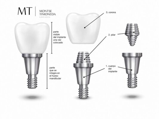 implantes dentales en clinica dental montse timoneda | Implantes dentales en Tarragona recupera tus dientes fijos con un tratamiento personalizado