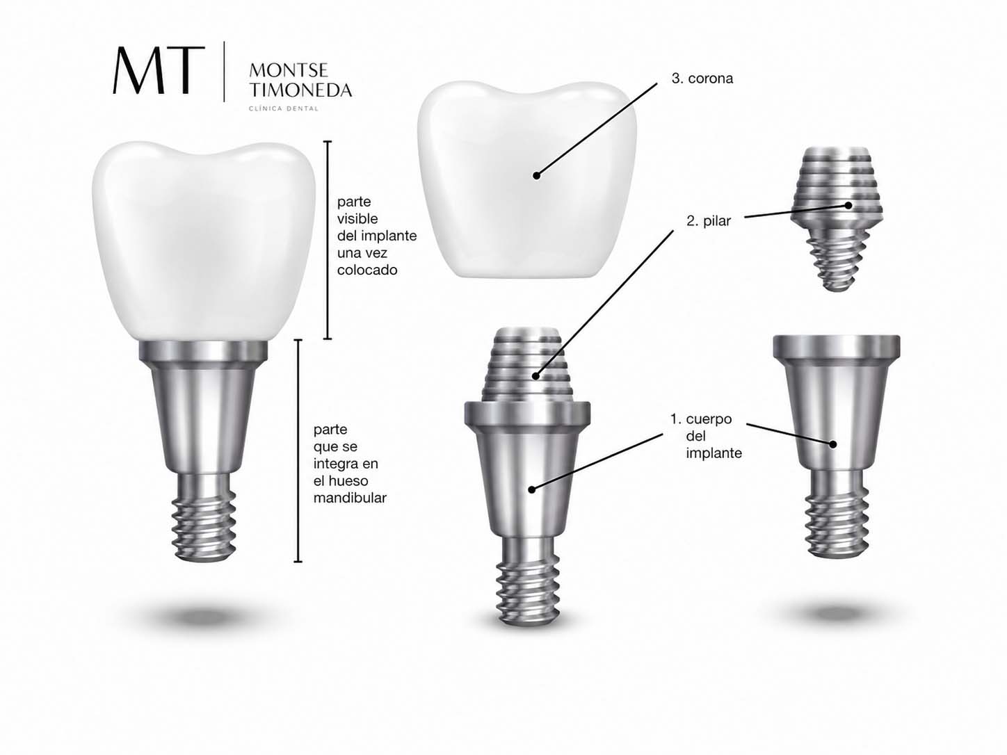 implantes dentales en clinica dental montse timoneda | Implantes dentales en Tarragona recupera tus dientes fijos con un tratamiento personalizado