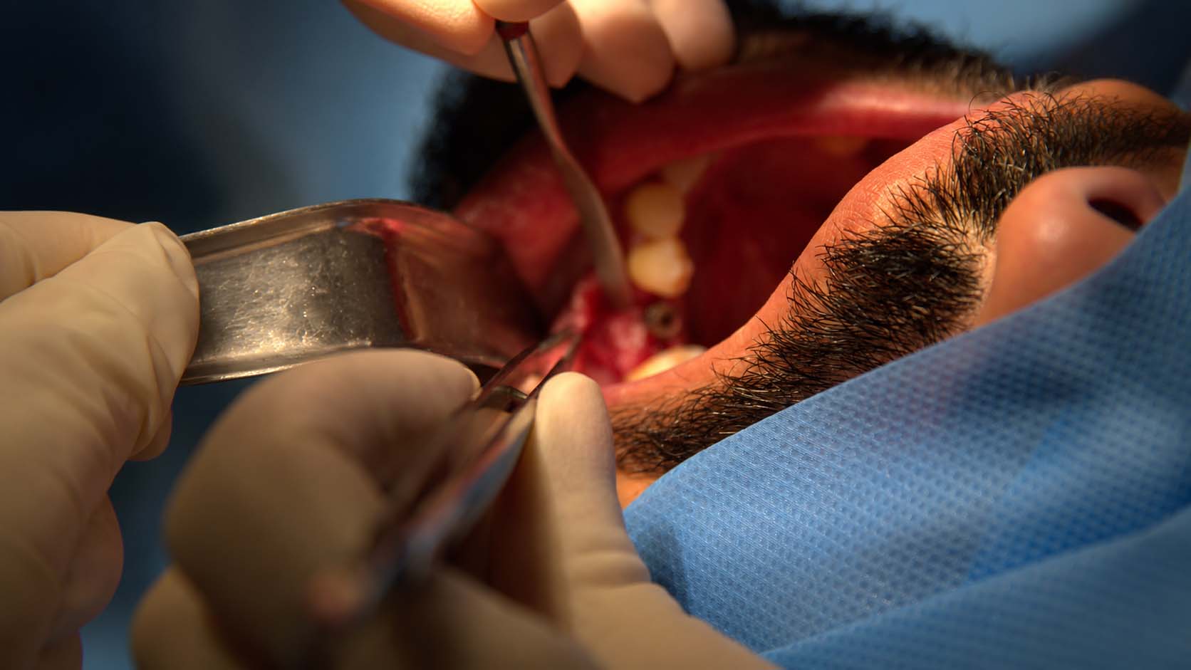 adicionales innecesarios | Injerto oseo para implantes dentales cuando es necesario y que alternativas existen