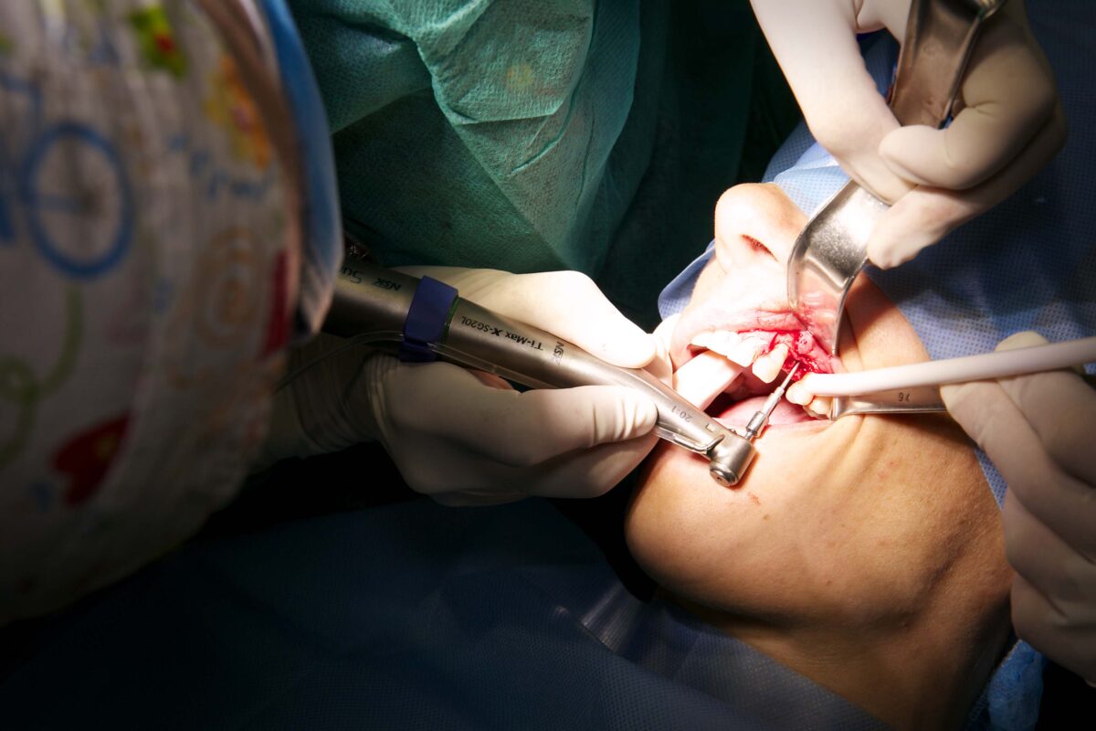realizar implante dental a un paciente en Tarragona | Se puede poner un implante dental si tengo poco hueso Descubre las opciones disponibles para tu caso