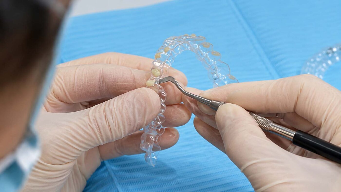 Desafios en movimientos de extrusion severa | Que problemas dentales puede corregir Invisalign Descubre si este tratamiento es adecuado para ti