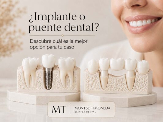 que es un puente dental no se si es mejor ponerme un implante o puente para mi caso | Implante dental o puente dental diferencias ventajas y cual elegir en cada caso