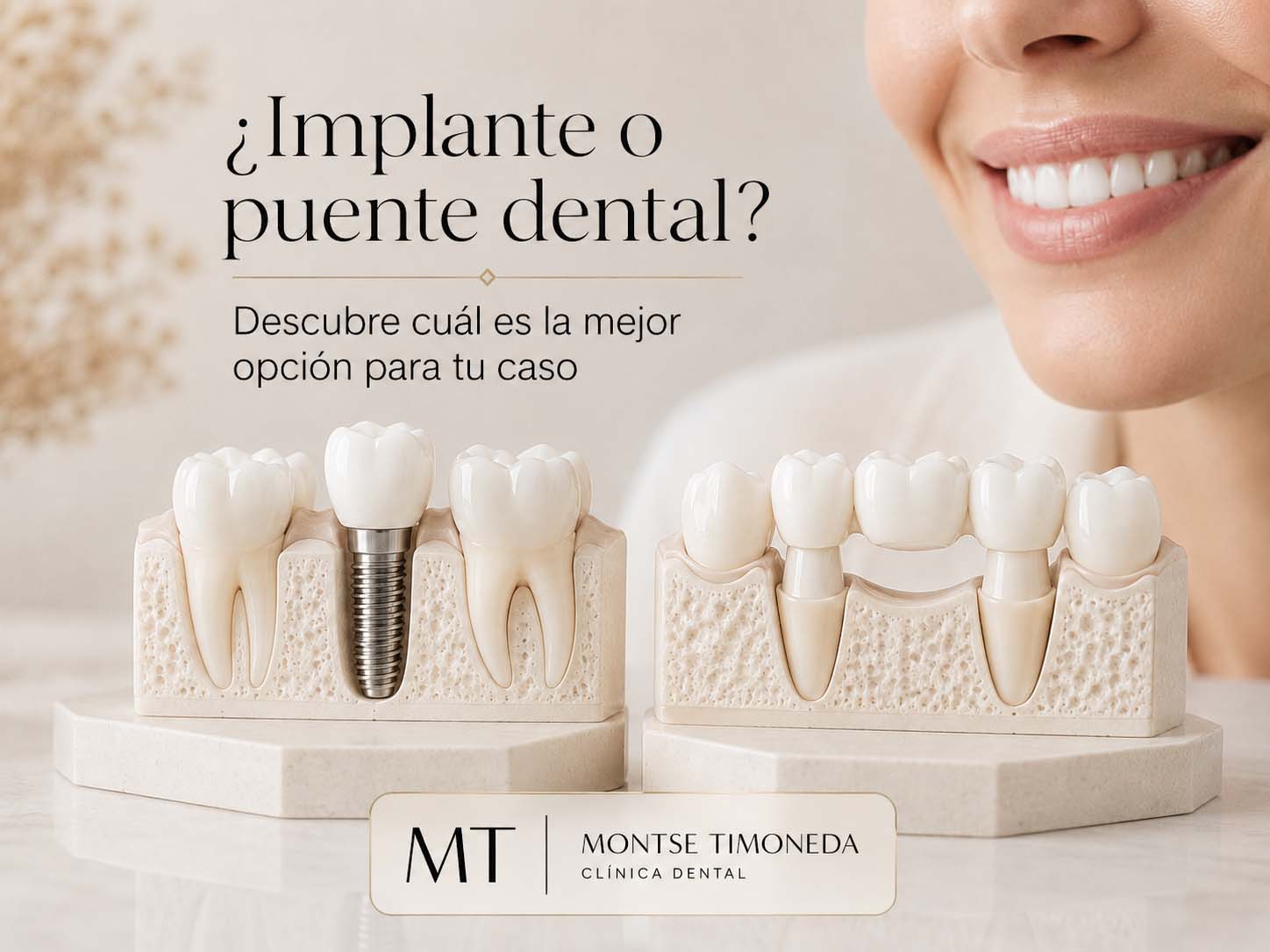 que es un puente dental no se si es mejor ponerme un implante o puente para mi caso | Implante dental o puente dental diferencias ventajas y cual elegir en cada caso