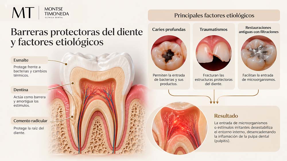 barreras protectoras del diente y factores etiologicos | pulpitis